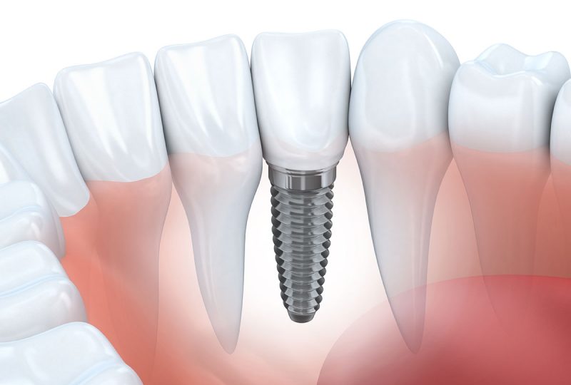 baldan-periodontics-dental-implants-001
