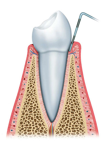 periodontitis-stage1